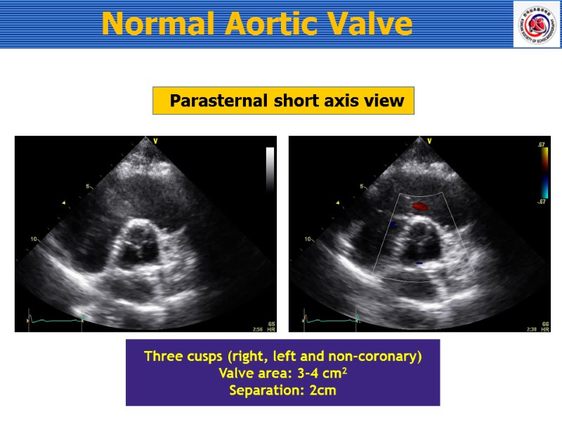 Parasternal short axis view Three cusps (right, left and non-coronary) Valve area: 3-4 cm2